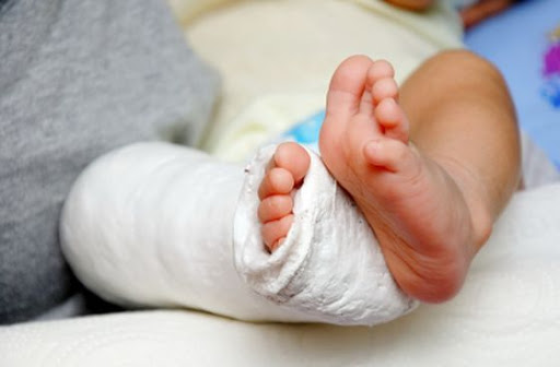 What is Clubfoot and How can it be Treated?